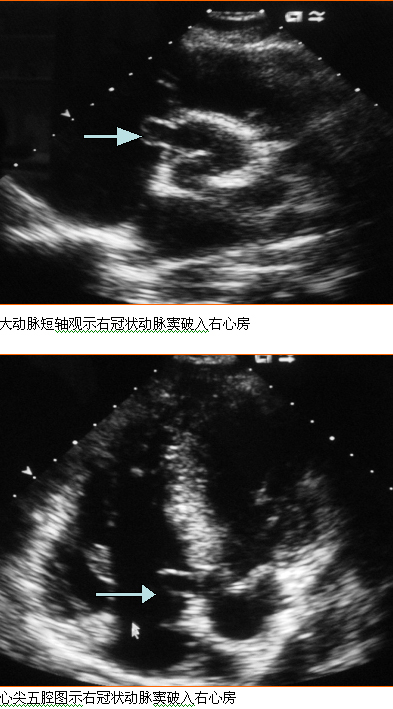 主动脉窦瘤破裂介入封堵成功一例 王广义